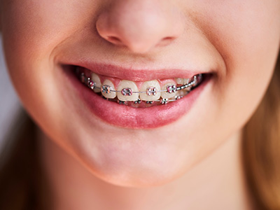 A young woman with a radiant smile, showcasing her braces and pink lipstick, against a plain background.