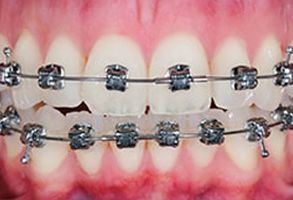 The image shows a close-up of a person s teeth with braces, featuring metal brackets and wire segments.