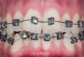 Dental implants with a diamond-studded bracket, showcasing a luxurious and unique dental accessory.
