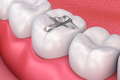 An image of a dental implant inserted into a toothless section of a human mouth, with visible pink gums and teeth on either side.