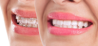 A close-up photograph of a smiling woman with pink lipstick, showcasing her dental implants.