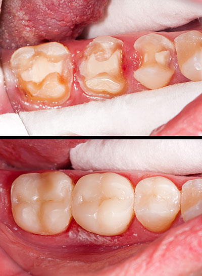 Before and after image of a dental procedure, showing a patient s mouth with decayed teeth before treatment and the same mouth after treatment.