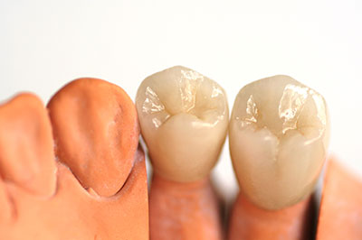 The image shows a set of artificial teeth placed in a row, with the upper teeth appearing to have a natural tooth color and texture, while the lower teeth have a distinct brownish-orange hue.