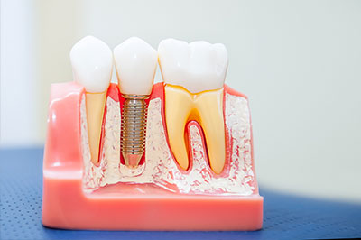 The image displays a pink model of a dental implant with a screw and teeth attached, set against a blue background.