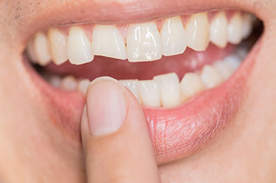 The image shows a close-up of a person s teeth, with the individual holding their finger in front of their mouth.