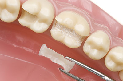 Close-up of a dental tray with a tooth containing a piece of filling material and a dental pick.