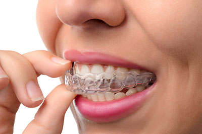 A person wearing a clear braces appliance, holding it with their fingers near their mouth.