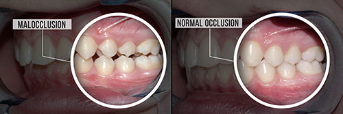 The image shows a before-and-after comparison of teeth, with the left side labeled  Malocclusion  and the right side labeled  Normal occlusion,  emphasizing the difference in dental alignment.