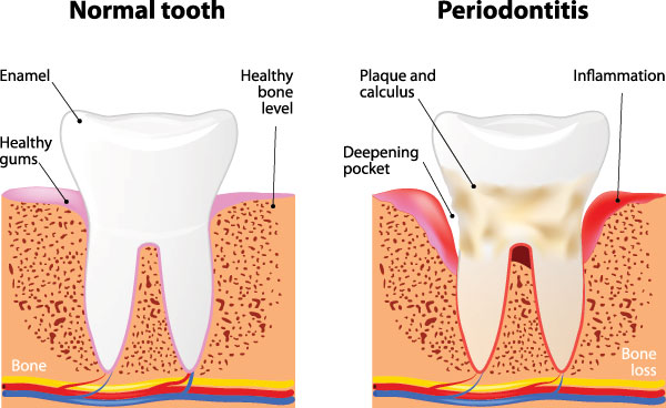 The image presents a detailed illustration of the structure and stages of tooth decay, from normal to advanced periodontitis, highlighting the progression of cavities and gum disease.