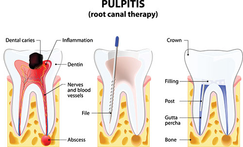 The image is a medical illustration showing a cross-sectional view of a tooth with pulpitis, highlighting inflammation and infection in the dental pulp.