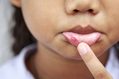 A young child with a small red mark on their skin, holding their finger to their lips.