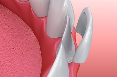 The image depicts a 3D rendering of a dental implant fixture with multiple spikes or prongs, set against a pink background that represents gum tissue.