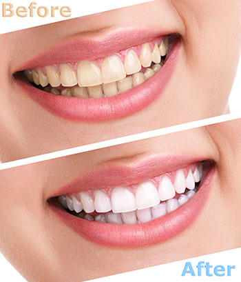 Before and after dental whitening display on a website, featuring two images of a person s smile with a prominent contrast between the discolored teeth in the  before  image and the brightly whitened teeth in the  after  image.