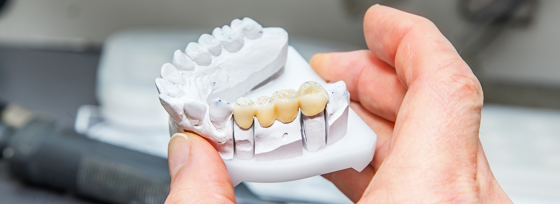 The image shows a person holding a dental implant with multiple teeth attached to it.