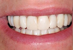 The image shows a close-up of a person s smile, revealing well-maintained teeth and a healthy oral appearance.