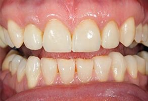 The image shows a close-up of a person s teeth with signs of discoloration, particularly yellowing and staining, which might suggest poor oral hygiene or the need for dental care.
