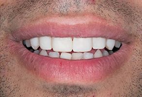 The image shows a close-up of a person s mouth with teeth, smiling broadly.