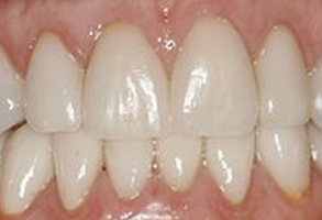 This is a close-up image of a person s teeth, showcasing their dental alignment and oral hygiene.