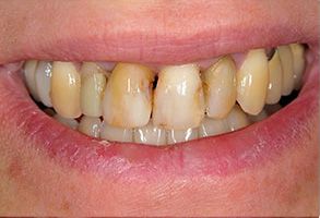 The image displays a close-up of a person s mouth with a yellowish tooth and gum discoloration, showing a smile with teeth that appear to be in poor condition.