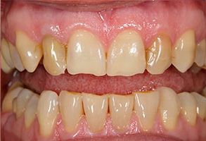 The image displays a close-up of a person s teeth with an emphasis on the yellowing and staining, likely for dental health or cosmetic purposes.