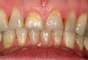 The image shows a close-up of a person s teeth, revealing yellowing and discoloration.
